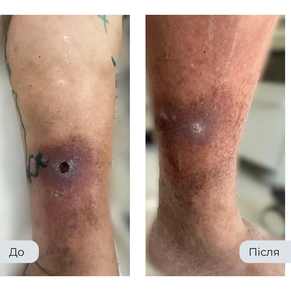 Результат лікування варикозу у флеболога Вадима Мальченка — фото до та після
