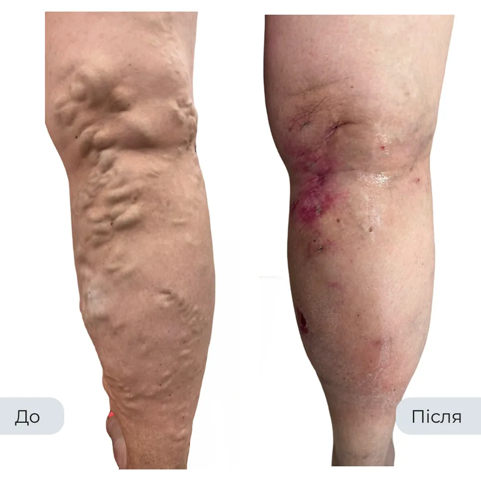 Результат лікування варикозу у флеболога Вадима Мальченка — фото до та після