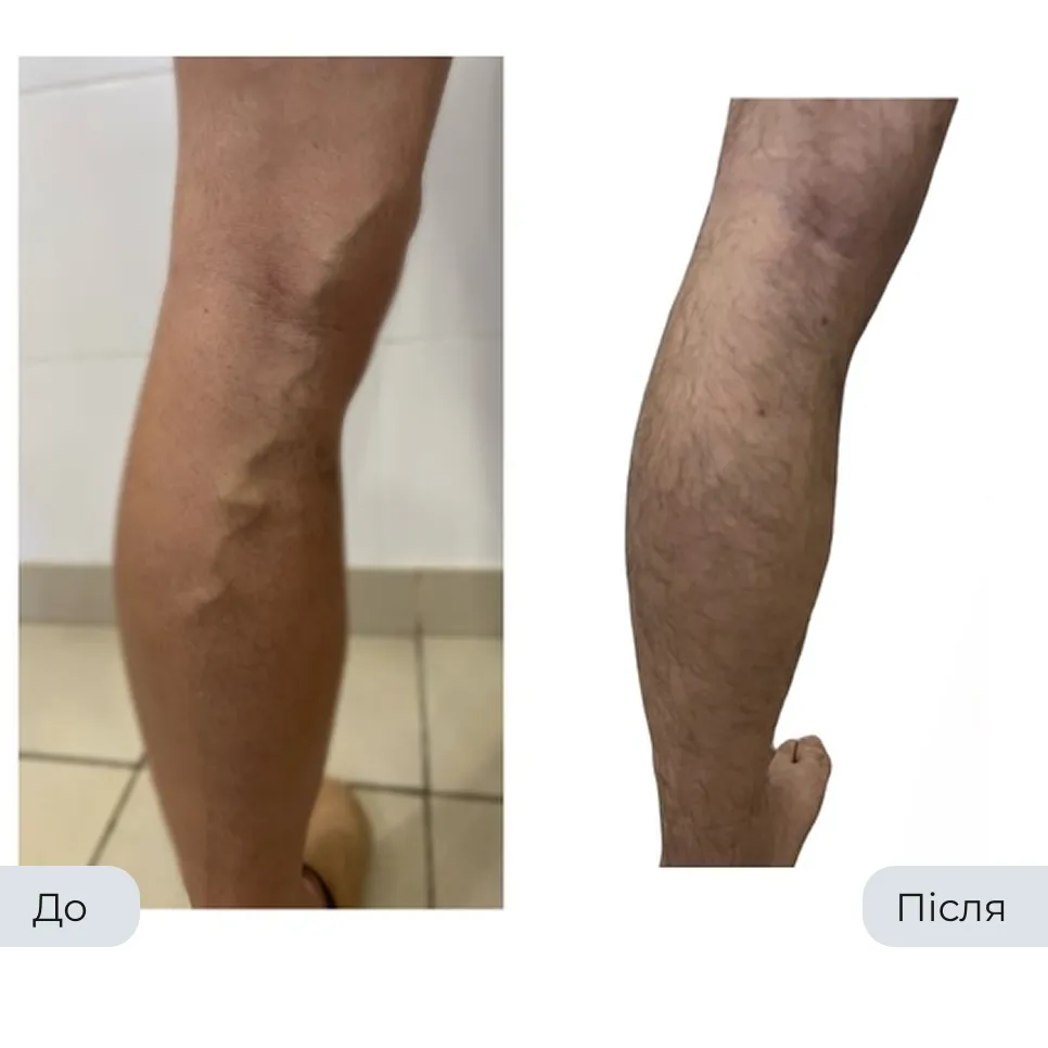Результат лікування варикозу у флеболога Вадима Мальченка — фото до та після