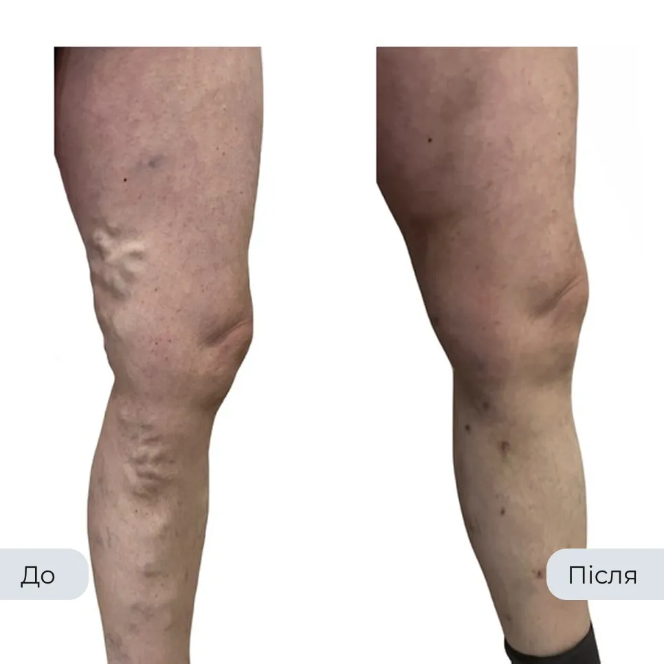 Результат лікування варикозу у флеболога Вадима Мальченка — фото до та після