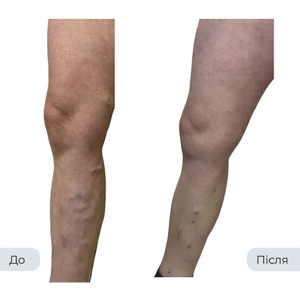 Результат лікування варикозу у флеболога Вадима Мальченка — фото до та після