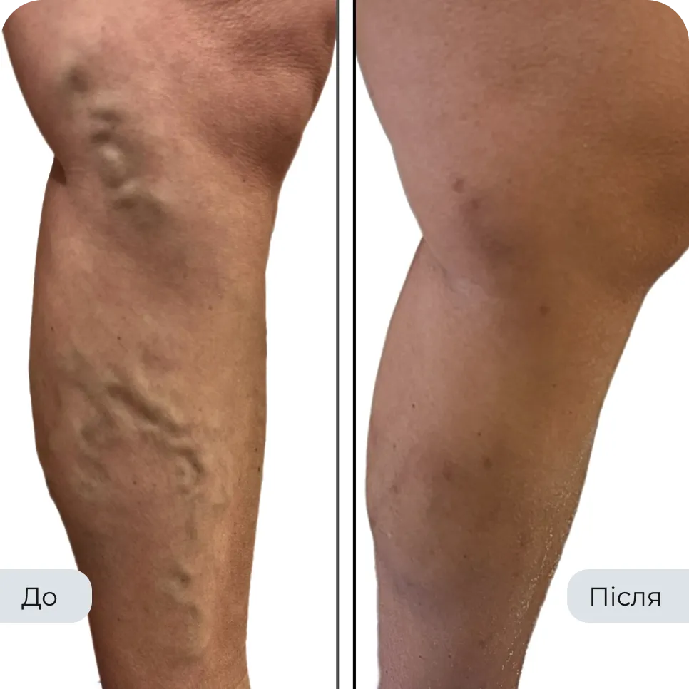 Результат лікування варикозу у флеболога Вадима Мальченка — фото до та після