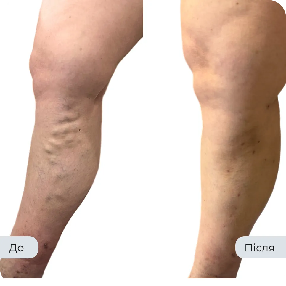 Результат лікування варикозу у флеболога Вадима Мальченка — фото до та після
