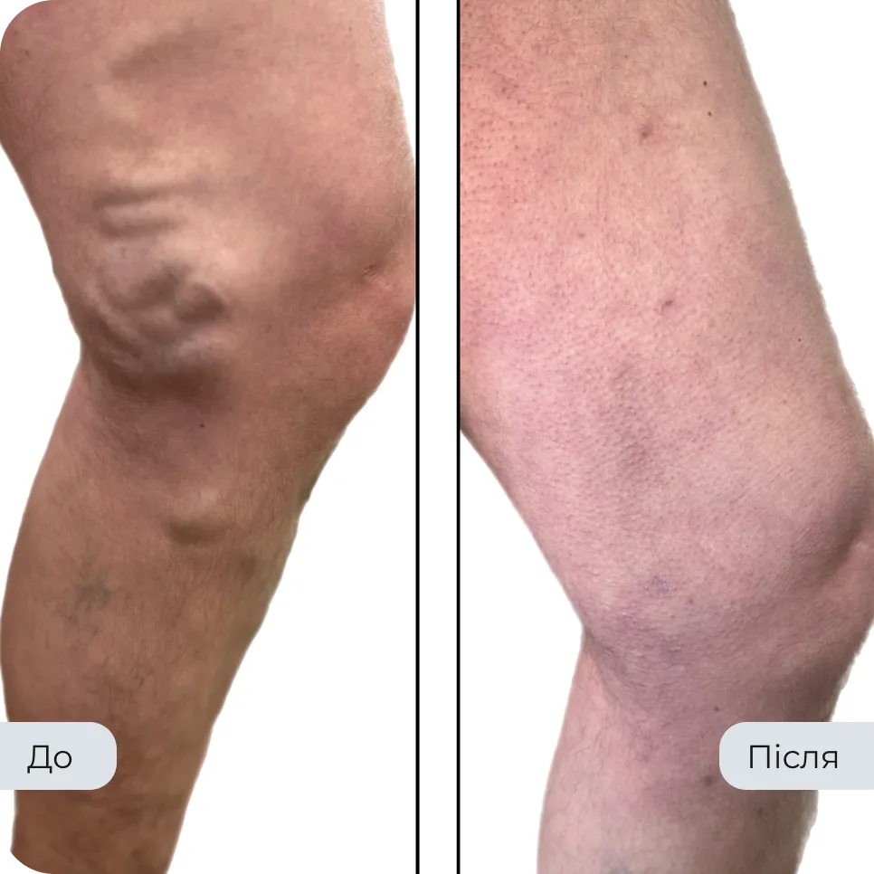 Результат лікування варикозу у флеболога Вадима Мальченка — фото до та після