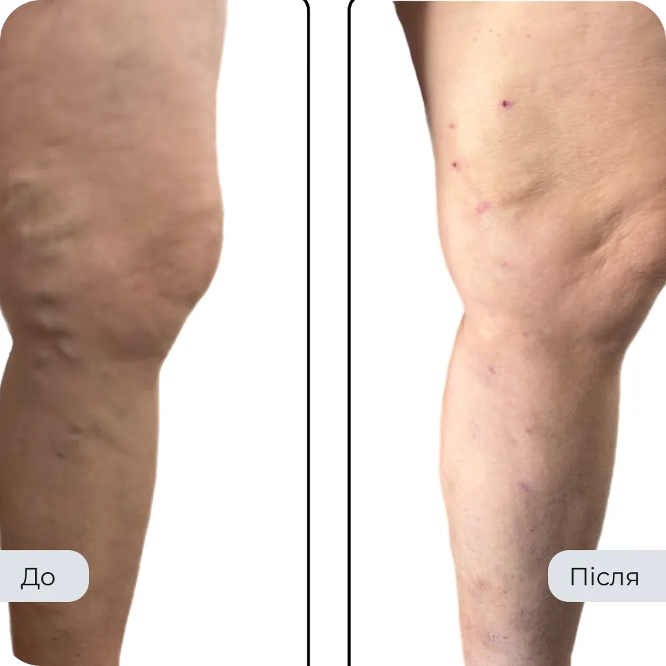 Результат лікування варикозу у флеболога Вадима Мальченка — фото до та після