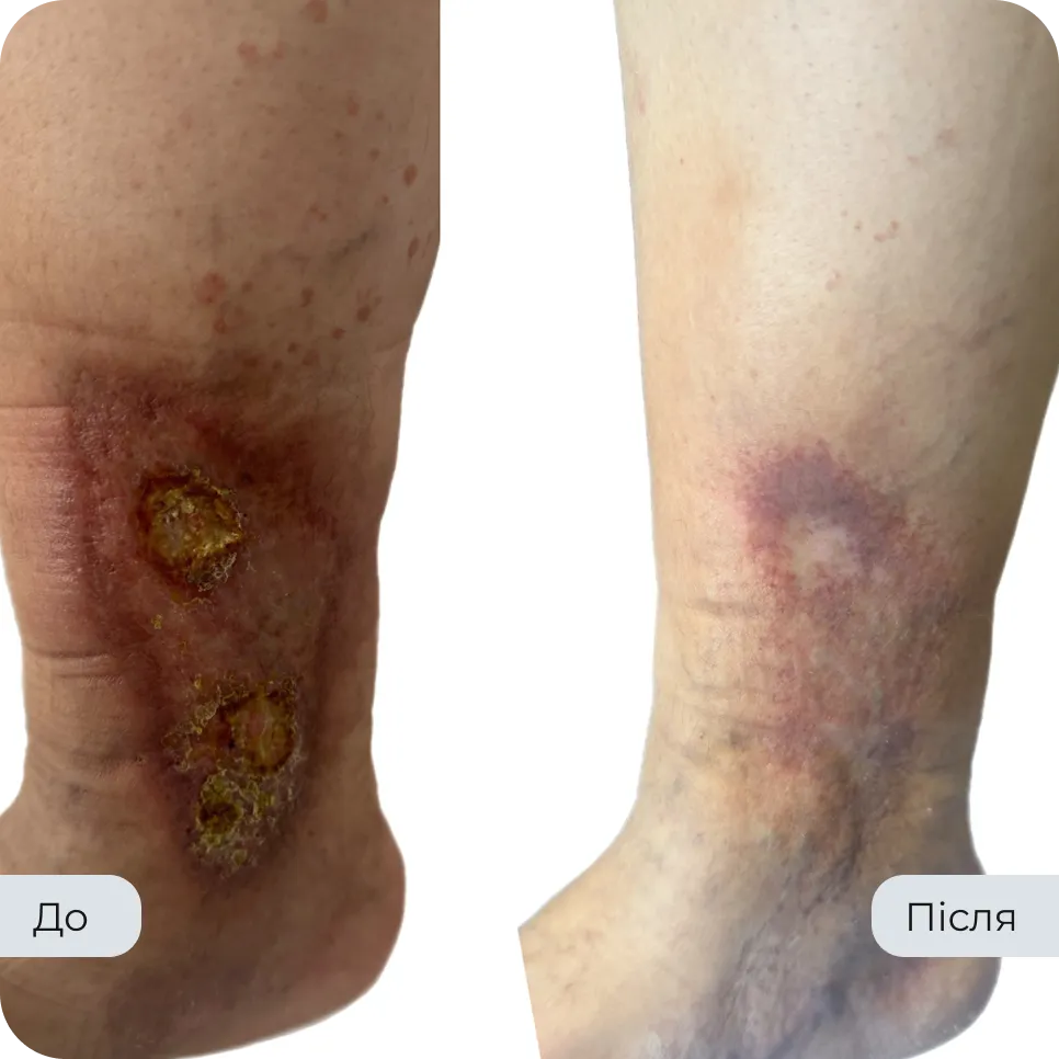 Результат лікування варикозу у флеболога Вадима Мальченка — фото до та після
