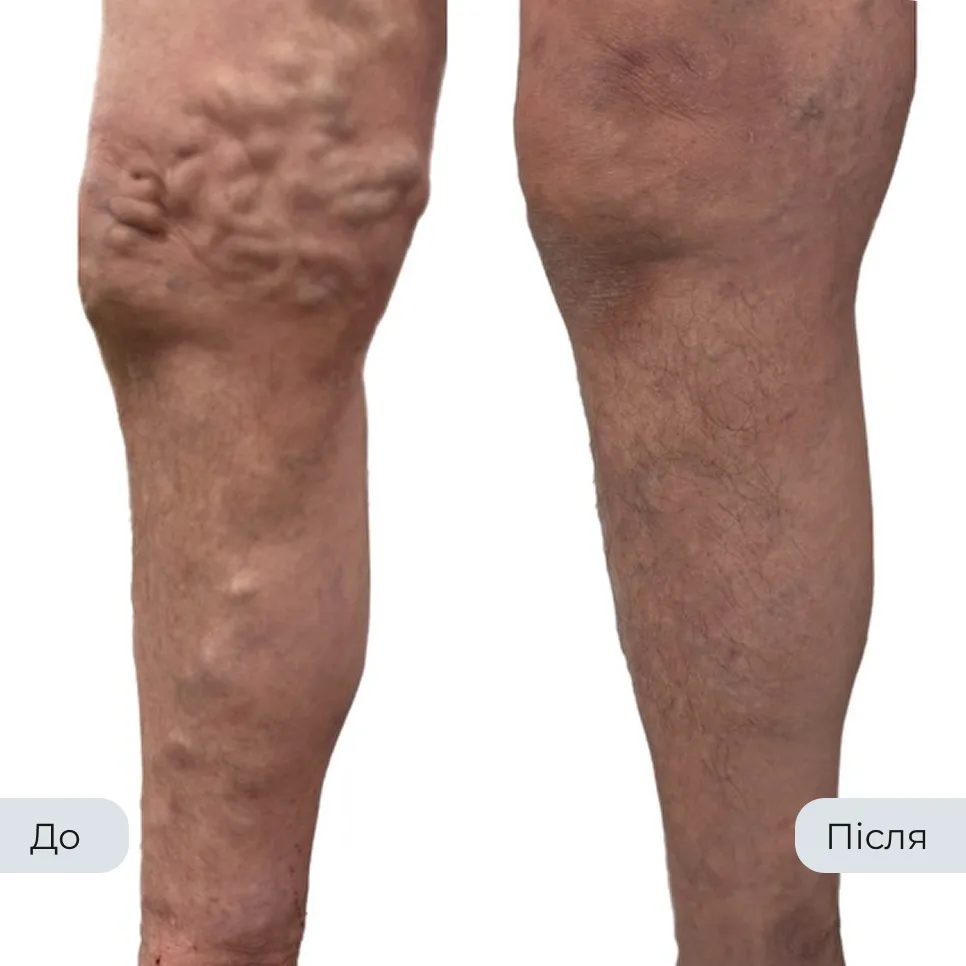 Результат лікування варикозу у флеболога Вадима Мальченка — фото до та після