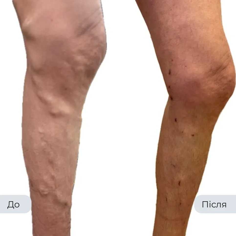Результат лікування варикозу у флеболога Вадима Мальченка — фото до та після