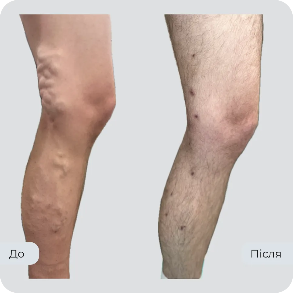 Результат лікування варикозу у флеболога Вадима Мальченка — фото до та після
