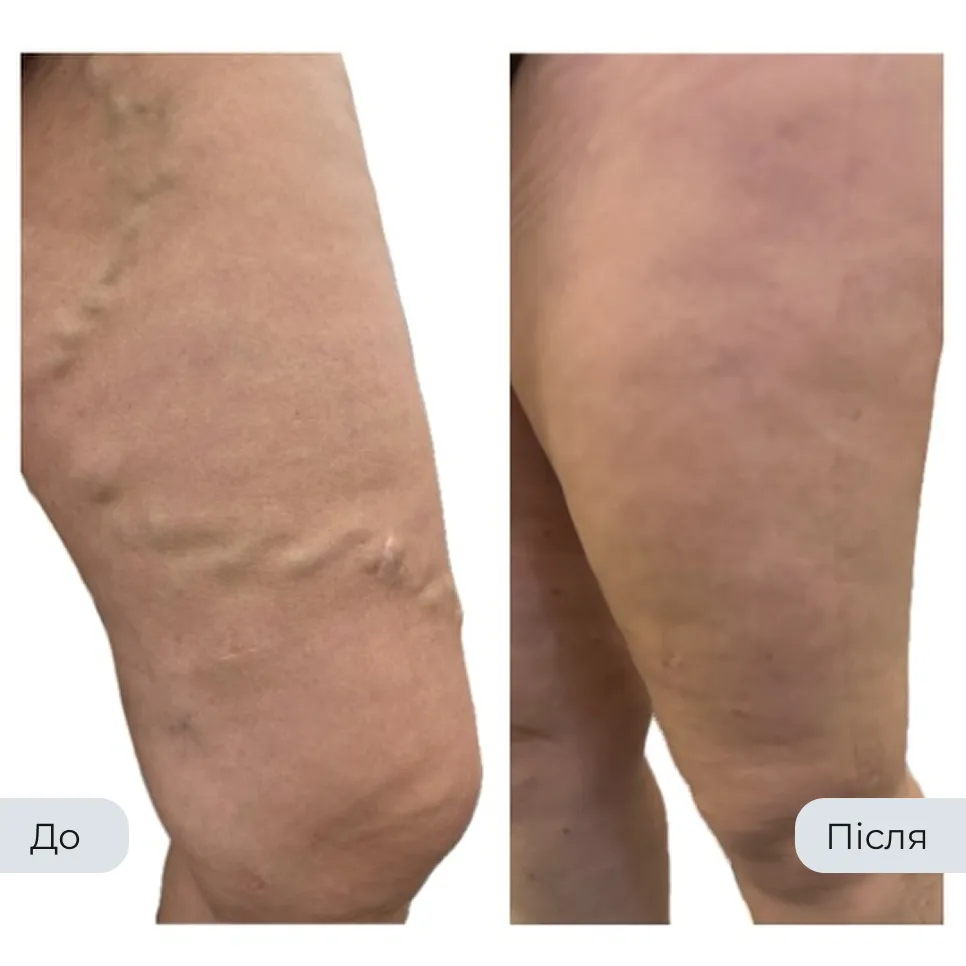 Результат лікування варикозу у флеболога Вадима Мальченка — фото до та після